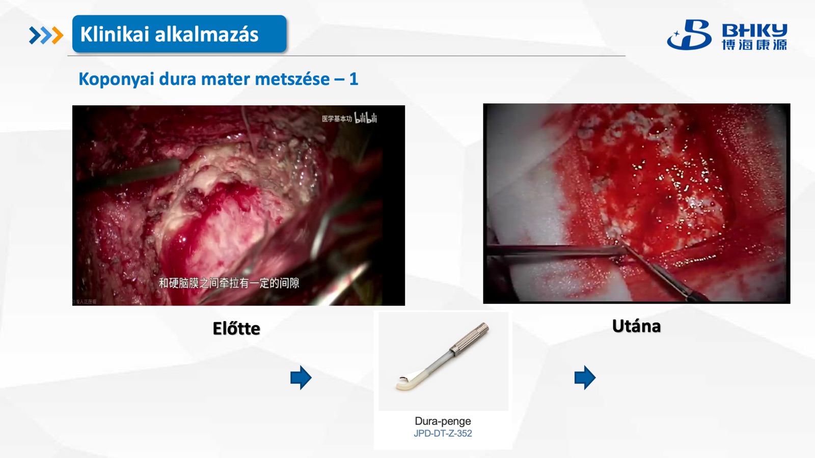 Klinikai alkalmazás — dura mater metszés 1