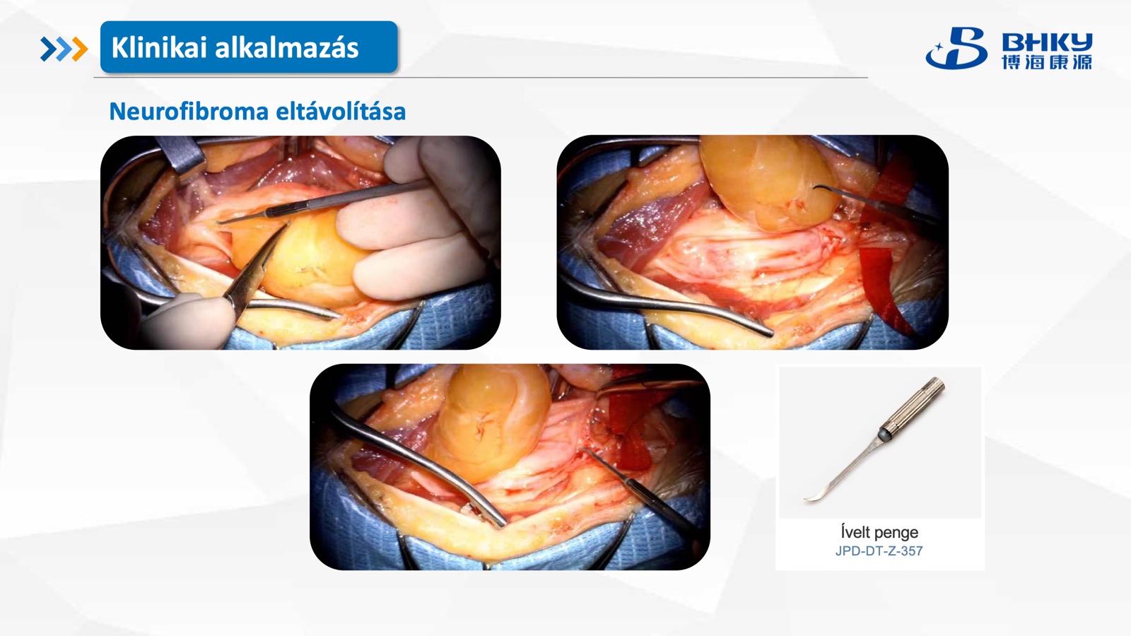 Klinikai alkalmazás — neurofibroma eltávolítás