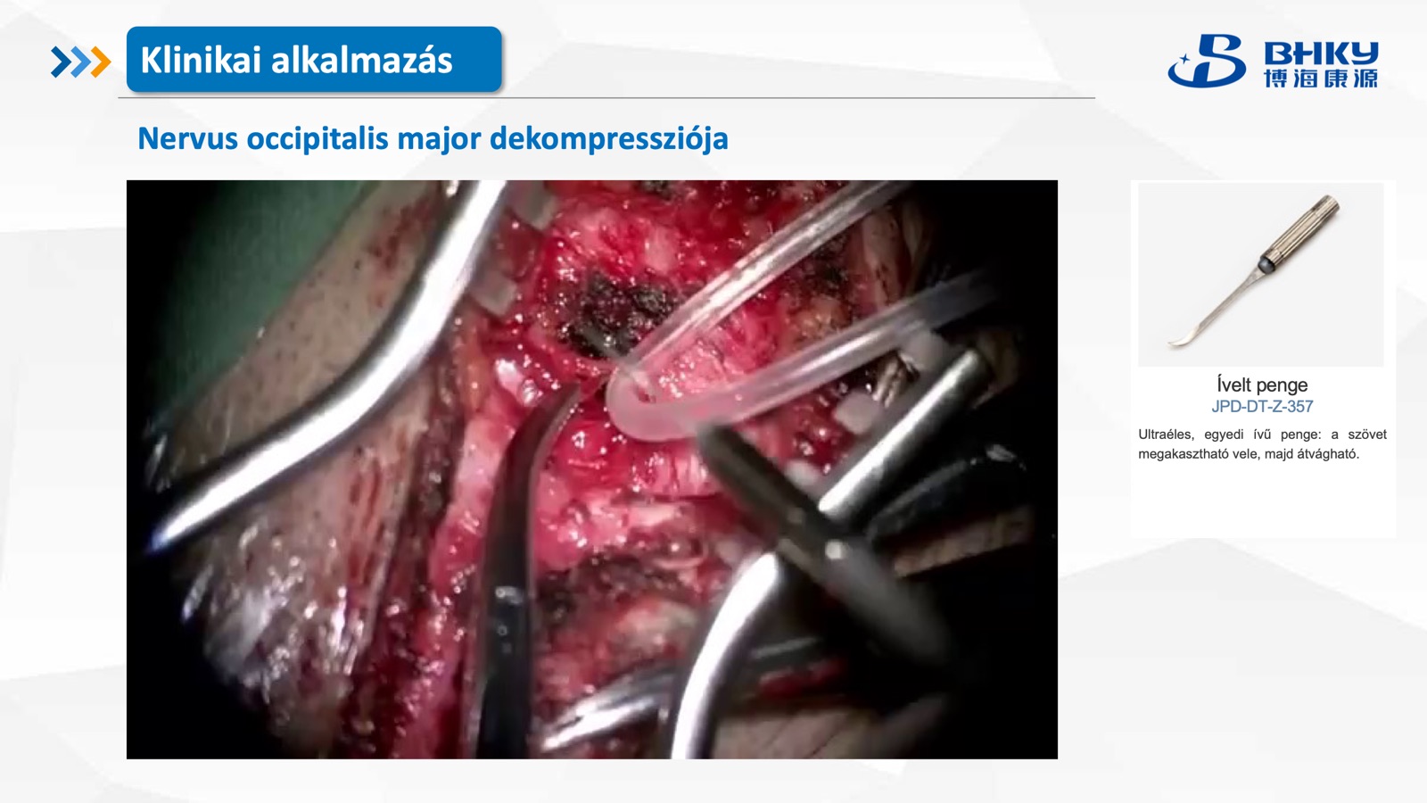 Klinikai alkalmazás — nagy occipitalis ideg dekompresszió