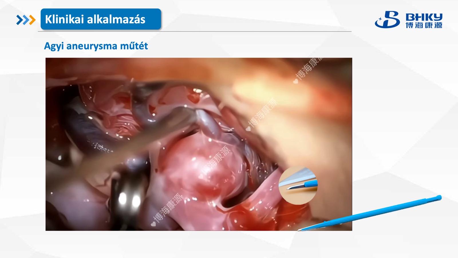 Klinikai alkalmazás — agyi aneurizma műtét